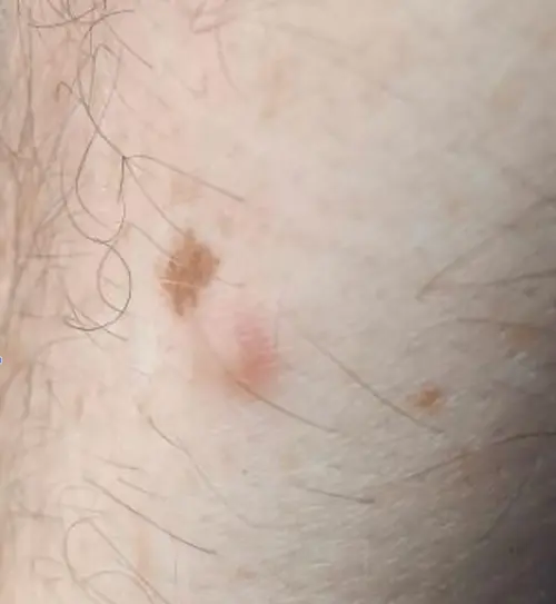 Blurred, angled close-up of two adjacent skin lesions, a brown pigmented mole and a raised red lesion, an example of poor focus reducing AI suggestion accuracy.
