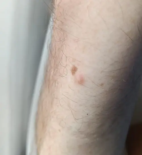 Two small skin lesions on a limb photographed from a distance, with surrounding skin, hair and background filling most of the frame, an example of too much in frame reducing AI suggestion accuracy.