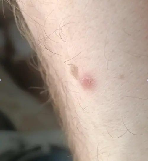 Two adjacent skin lesions, a brown mole and a raised red lesion, lit unevenly with a dark background, an example of harsh lighting reducing AI suggestion accuracy.